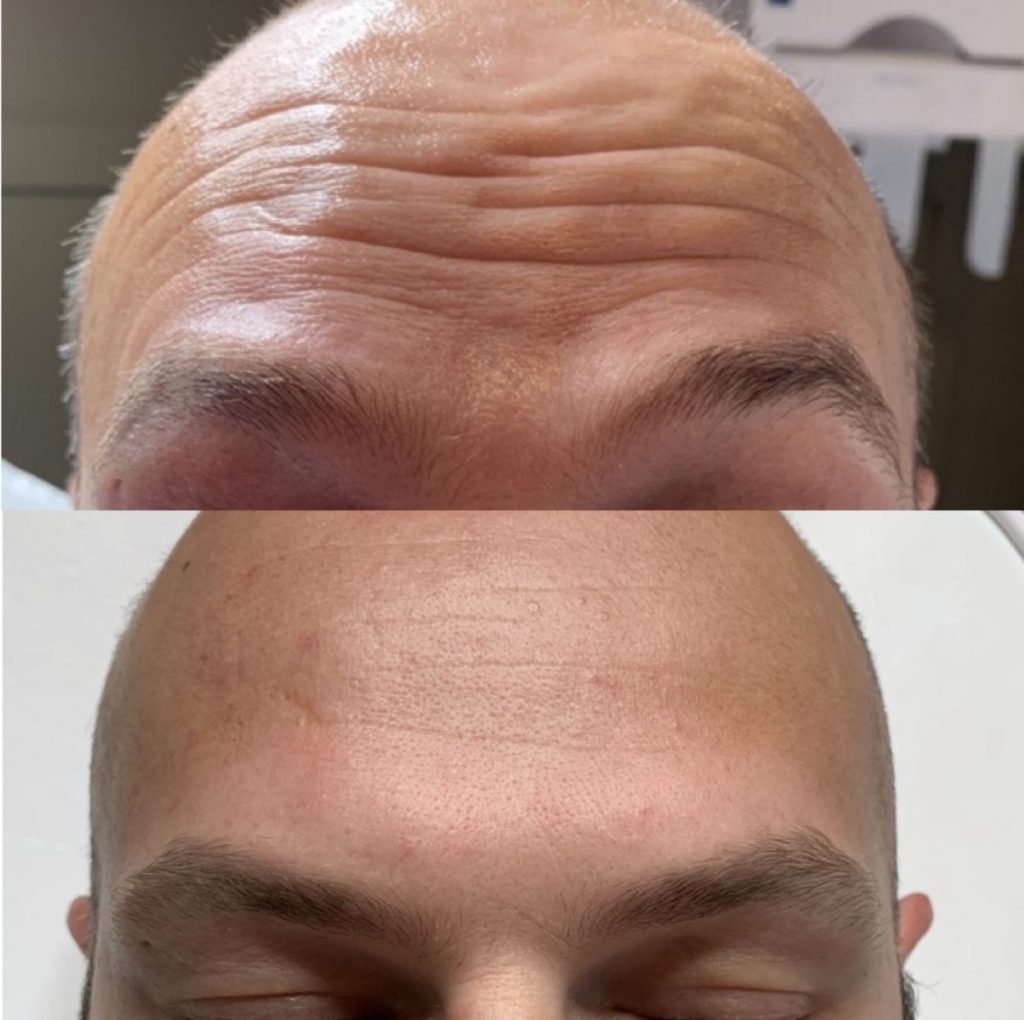 anti-wrinkle injections for forehead