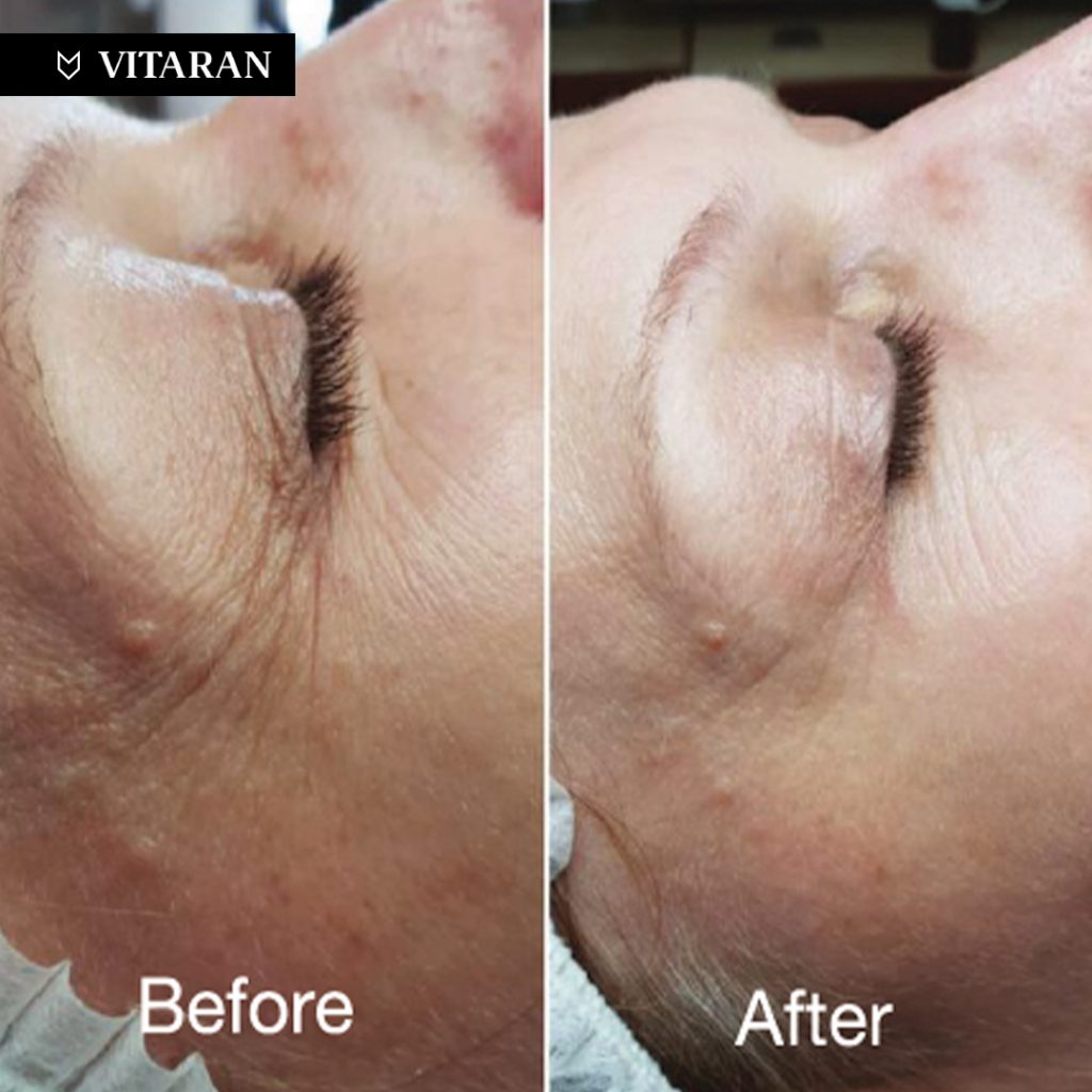 vitaran eye results