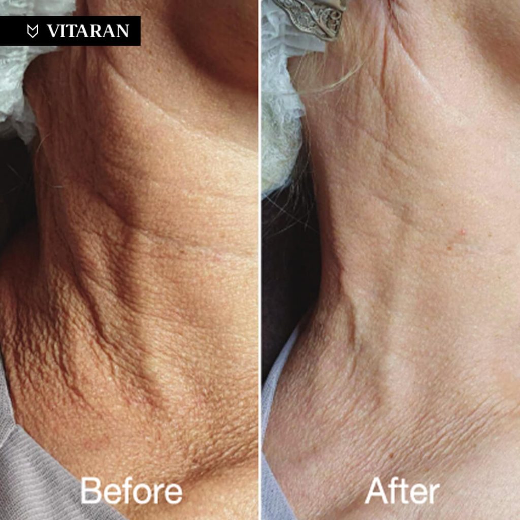 vitaran results neck