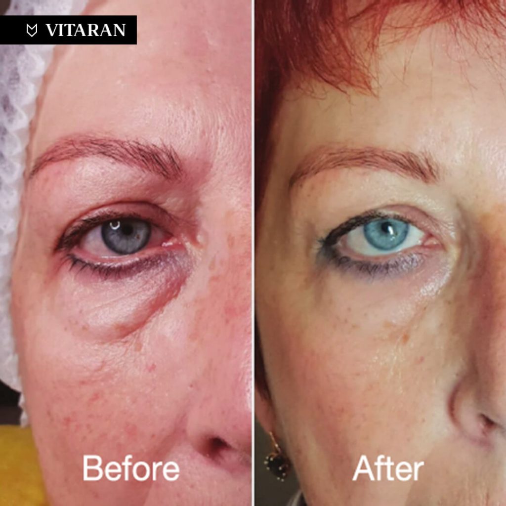 vitaran eye results