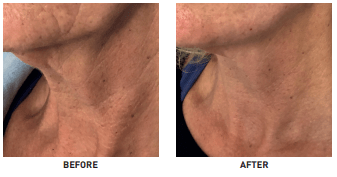 profhilo neck