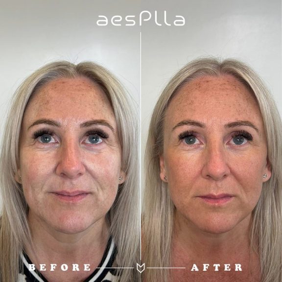 aesplla before and after