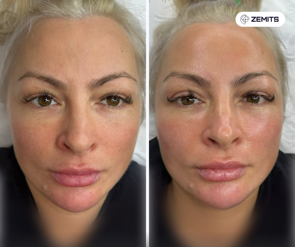 facials birmingham before and after result