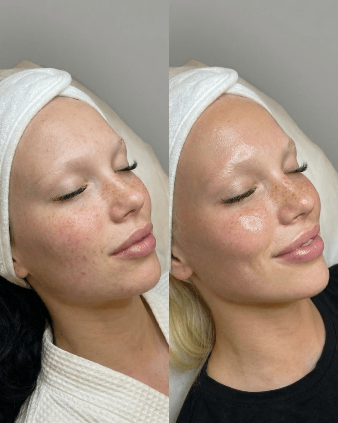 glass skin facial results birmingham