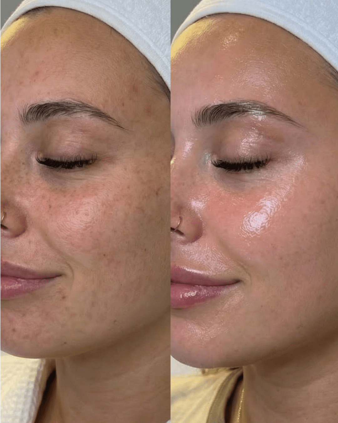 glass skin facial results sorelle skin clinic in birmingham