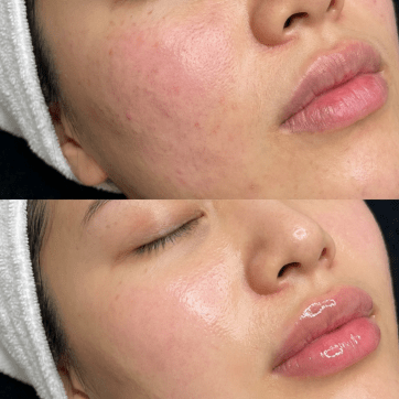 Skin Boosters: The Treatment Your Skin Has Been Waiting For