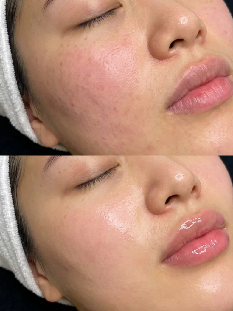 Best Facial Treatments for Glowing Skin