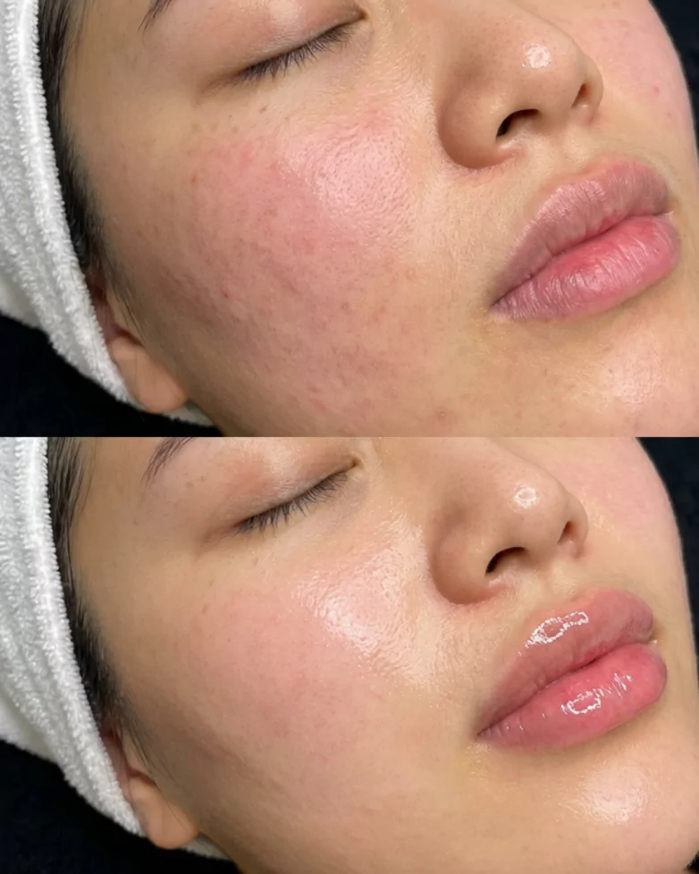 Best Facial Treatments for Glowing Skin