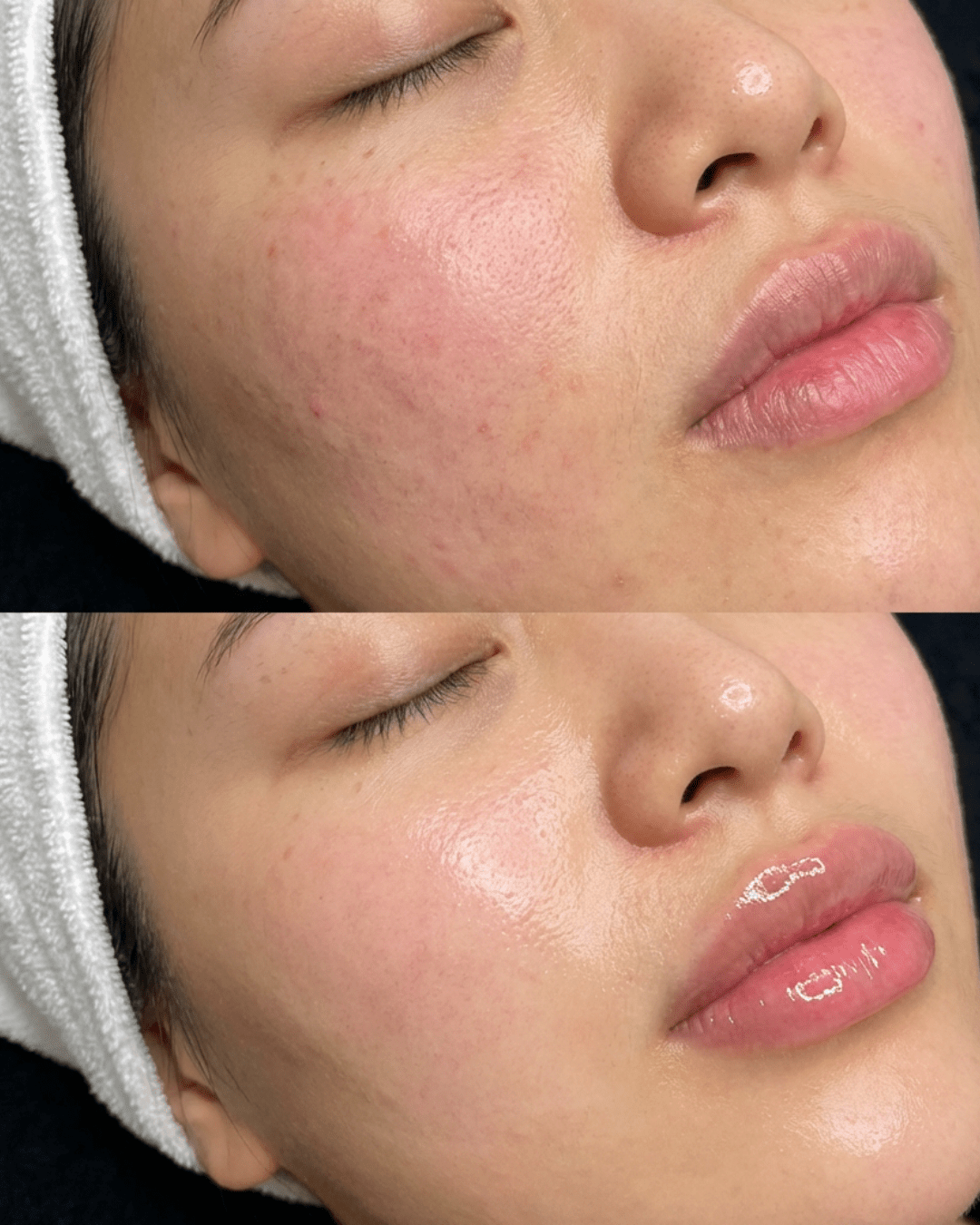 Best Facial Treatments for Glowing Skin