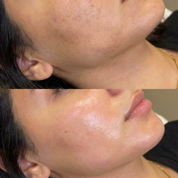 Korean Facial vs Hydrafacial