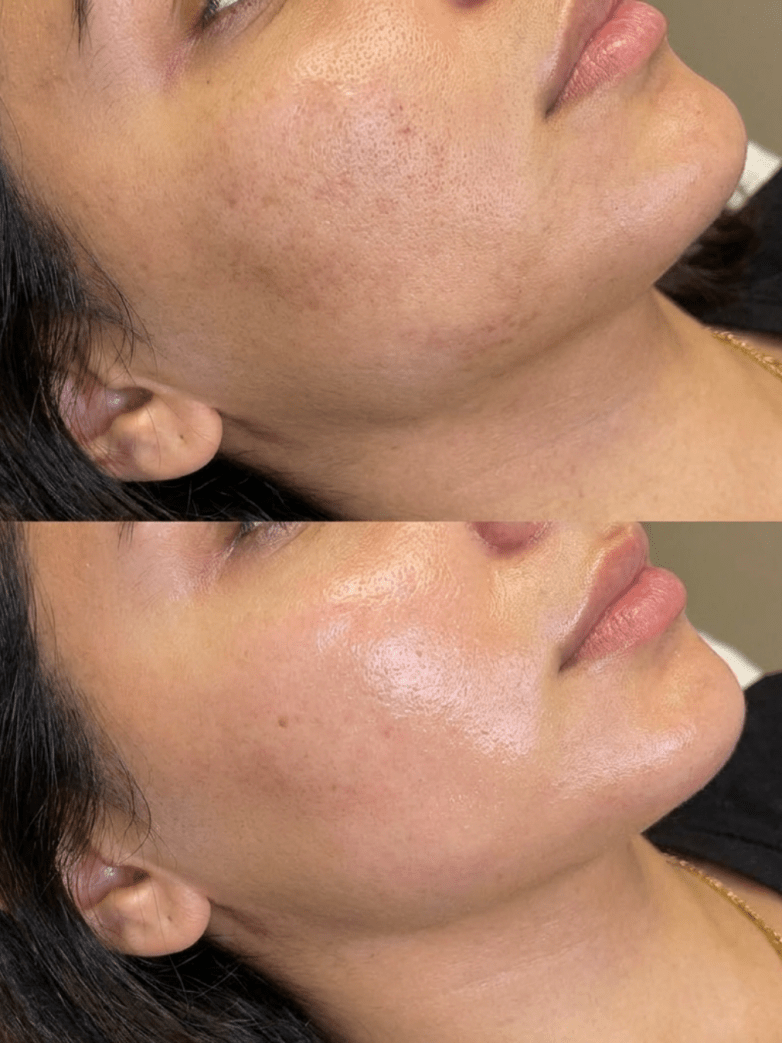 Korean Facial vs Hydrafacial