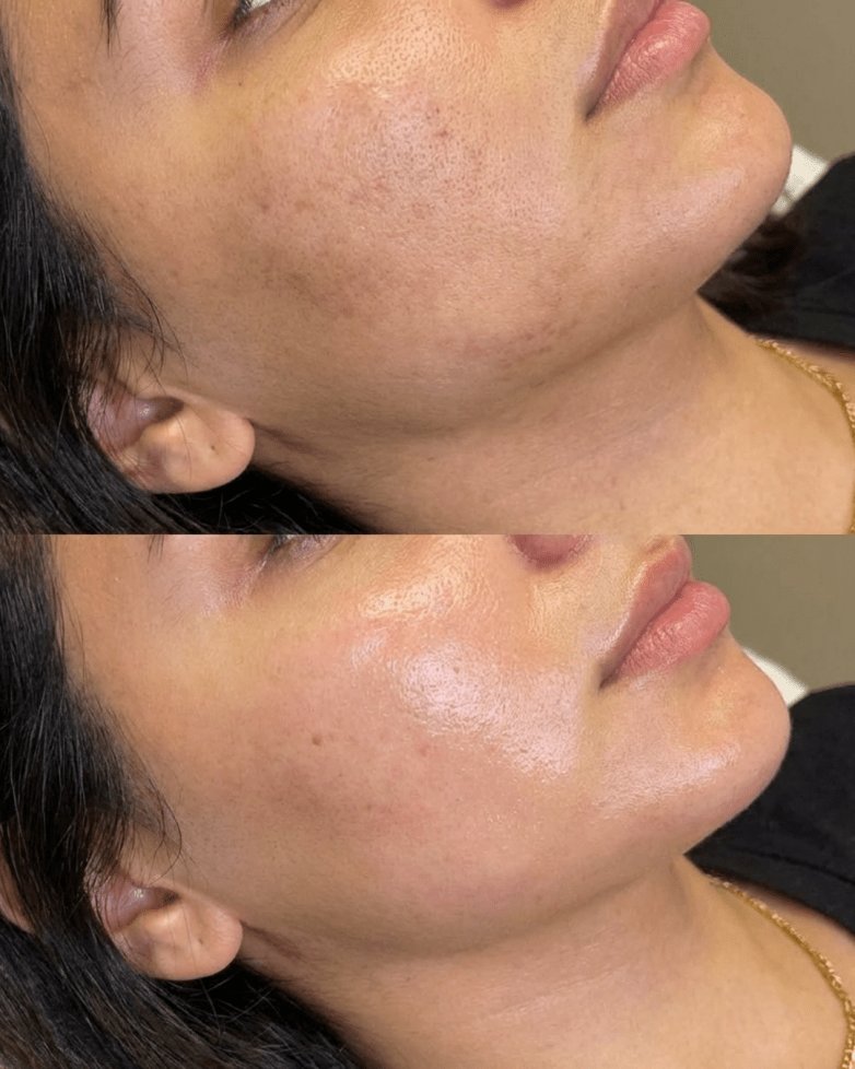 glass skin facial before and after results sorelle skin clinic birmingham
