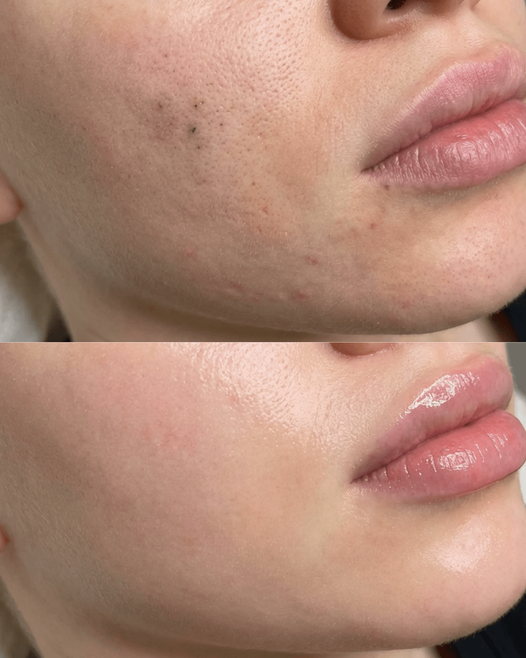 glass skin facial birmingham results korean facial treatment birmingham