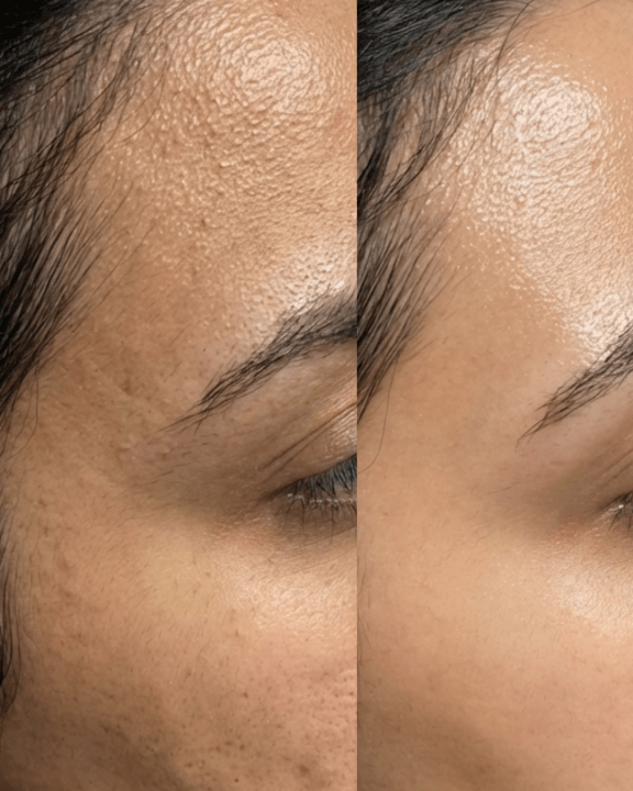 Hydrafacial treatment in Birmingham