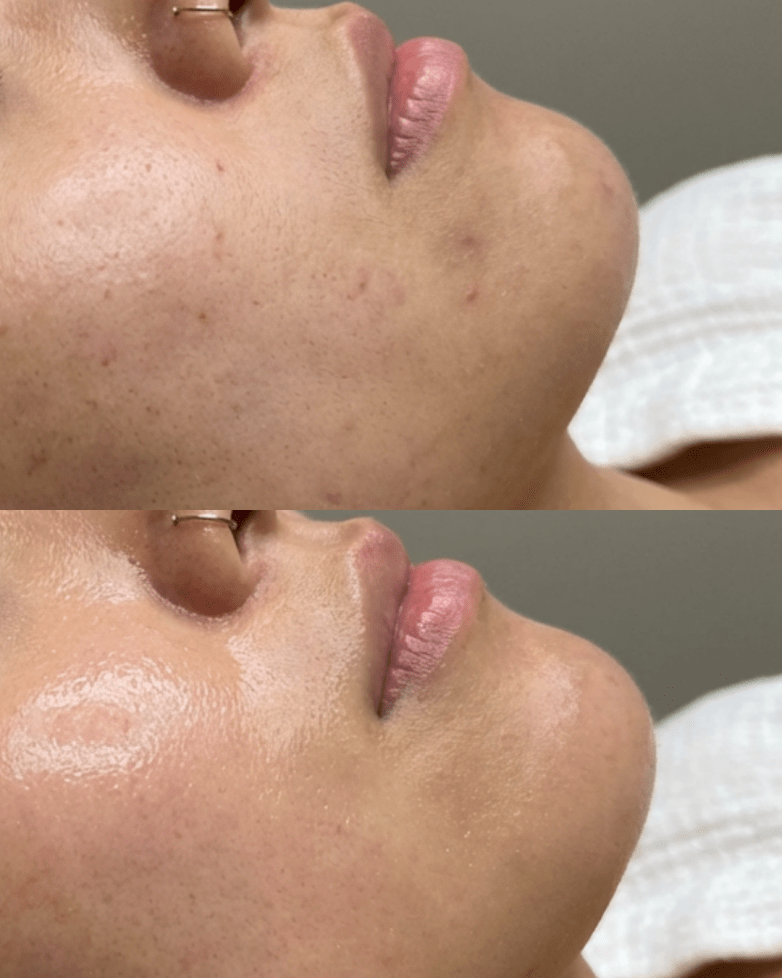 Hydrafacial treatment in Birmingham