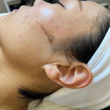 The benefits of Dermaplaning
