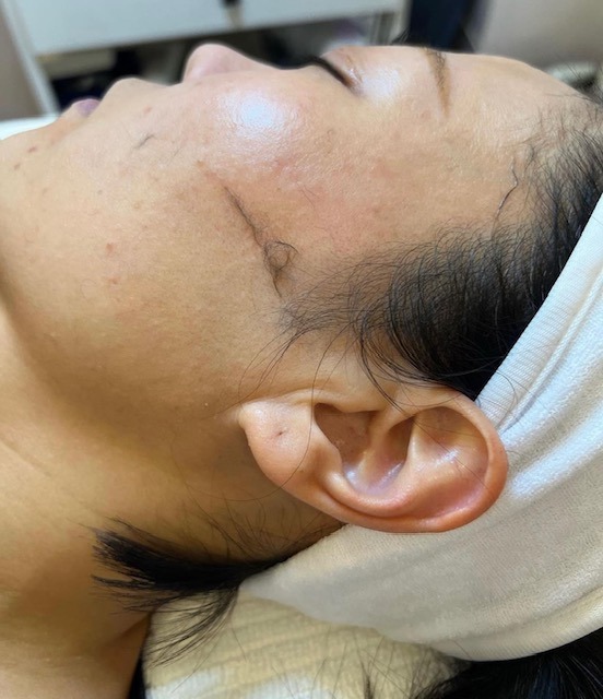 The benefits of Dermaplaning