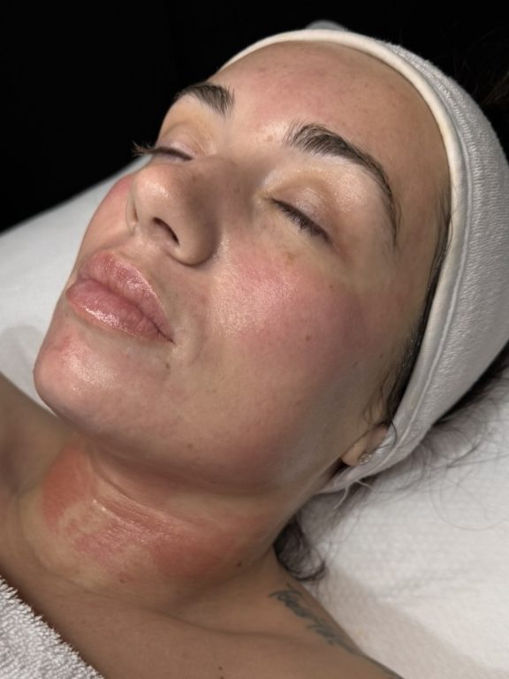 client after the rejuvenate facial in sorelle aesthetics birmingham