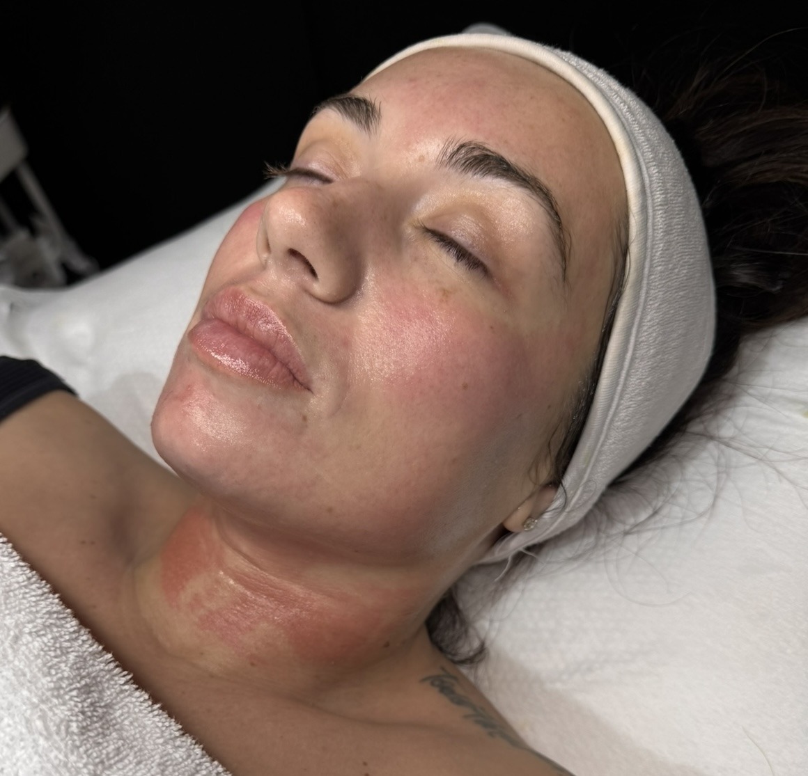 the rejuvenate microneedling birmingham