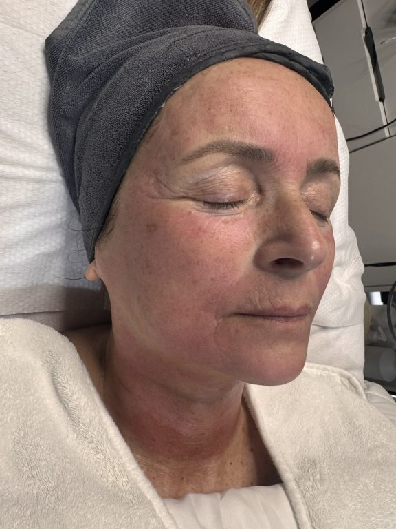 microneedling birmingham