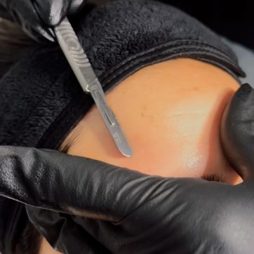 Dermaplaning Near Me in Birmingham – Is It Right for Your Skin?