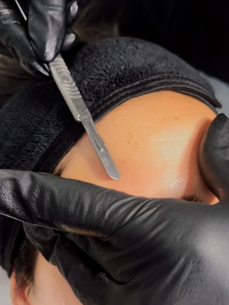 Dermaplaning Near Me in Birmingham – Is It Right for Your Skin?
