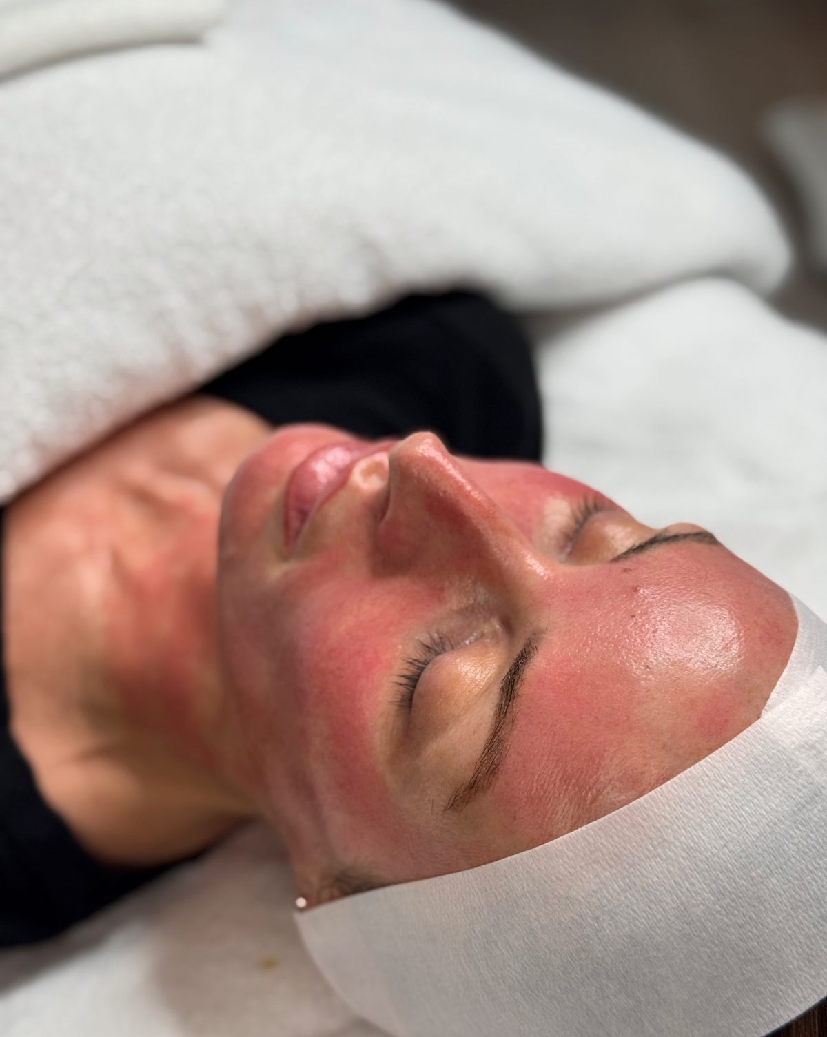 the fusion facial microneedling with exosomes