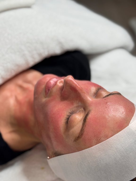 the fusion facial microneedling with exosomes