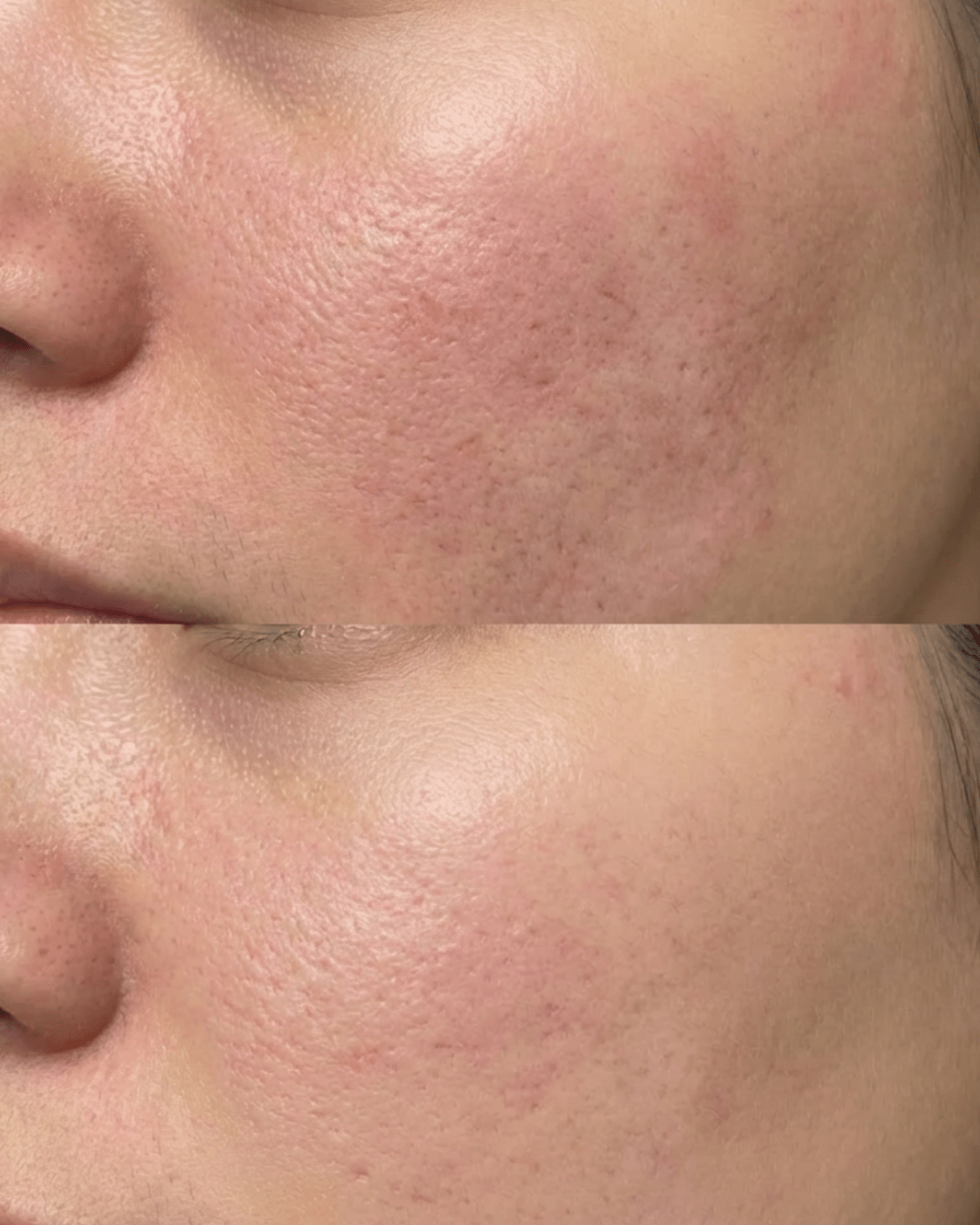 salmon sperm facial PDRN in birmingham before and after
