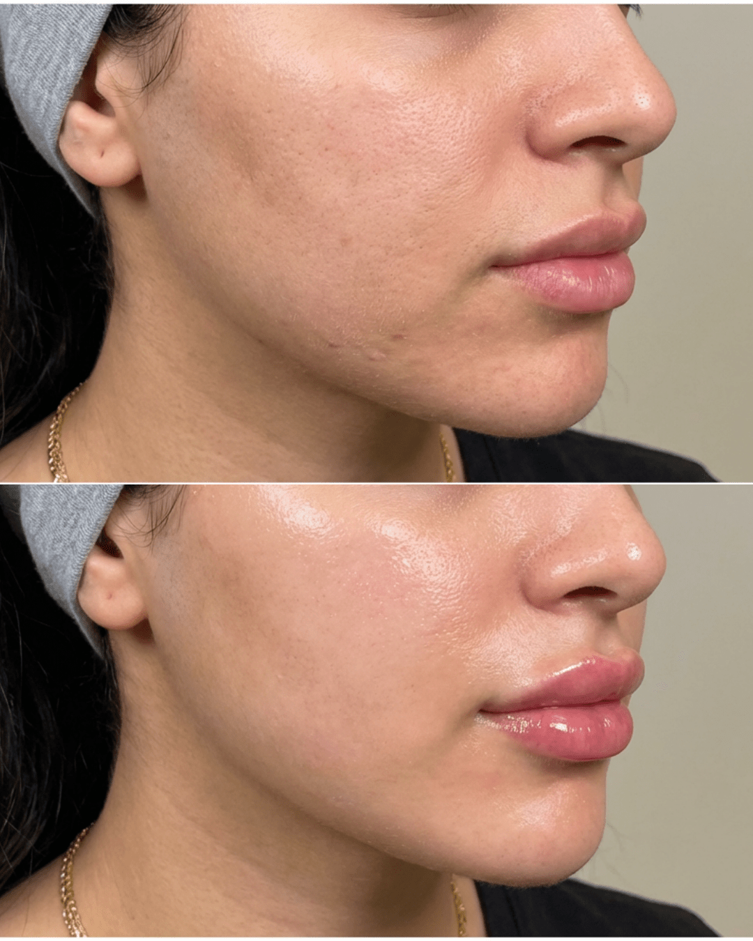 PDRN salmon DNA facial