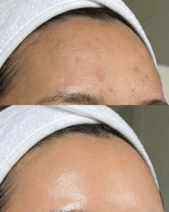 the fusion facial birmingham