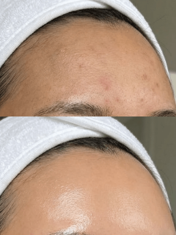 the fusion facial birmingham