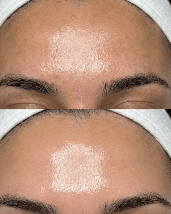 chemical peel birmingham
