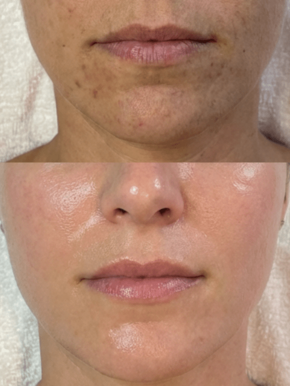 chemical peels birmingham