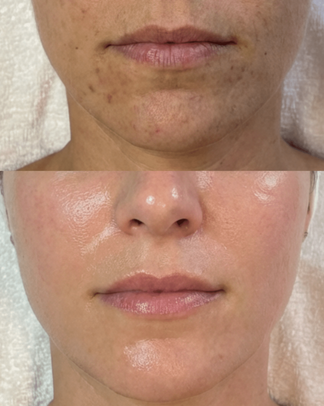 chemical peels birmingham