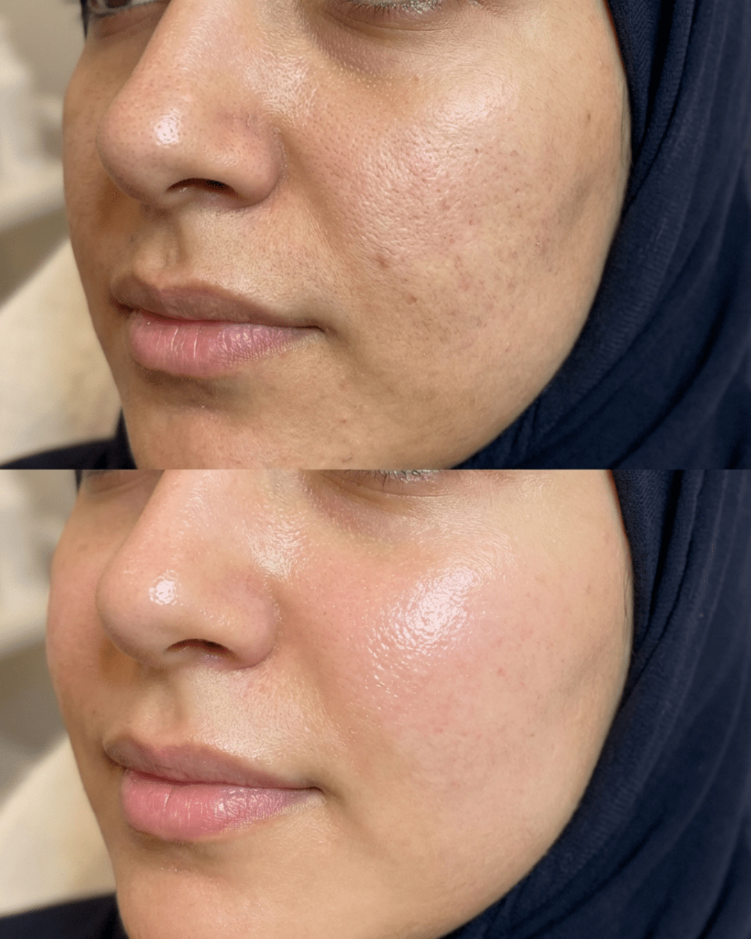 hydrodiamond hydrafacial birmingham