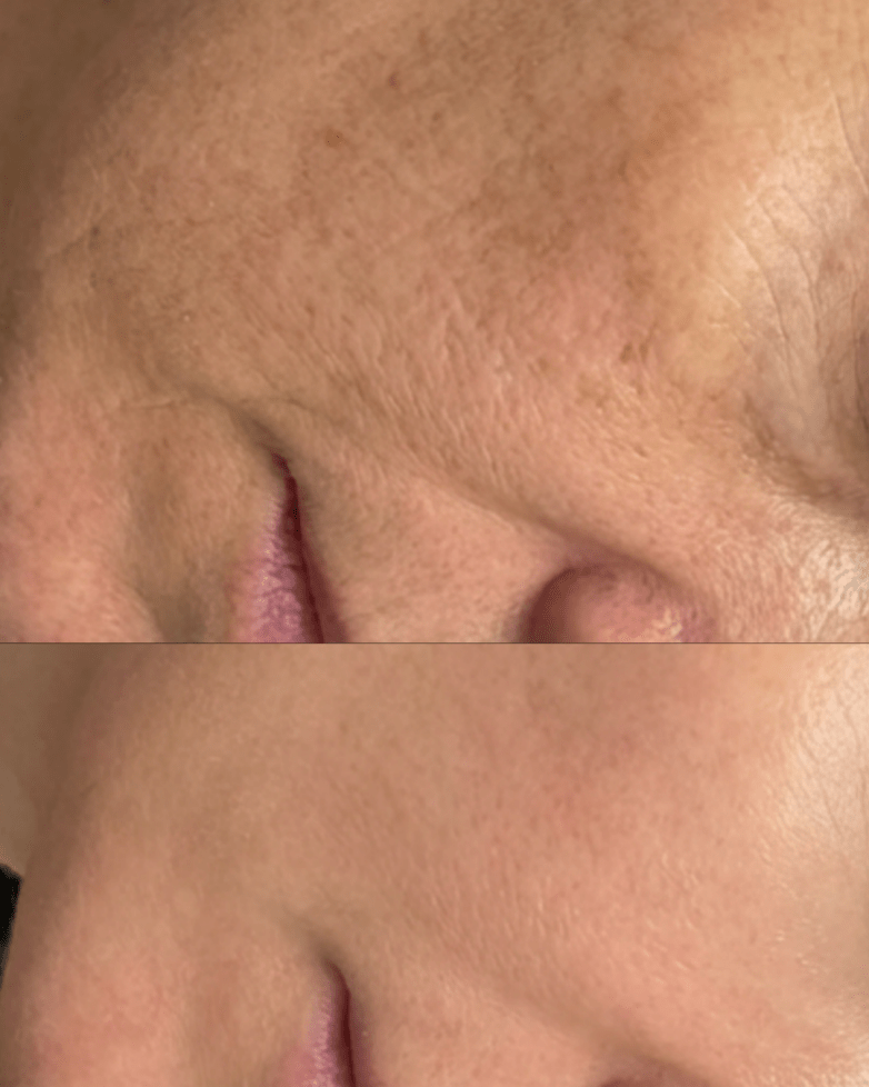 PDRN Salmon Sperm facial