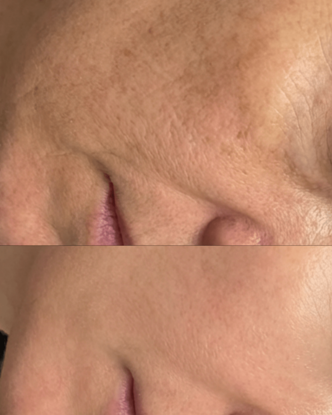 PDRN Salmon Sperm facial