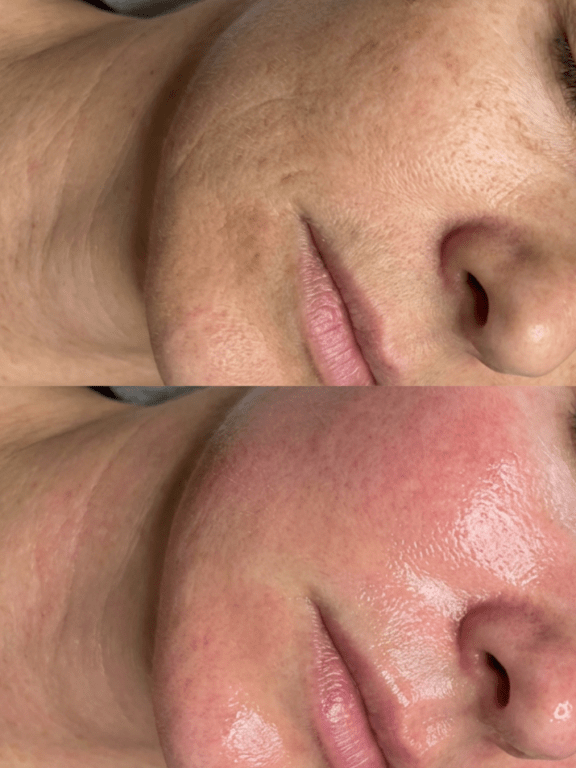 microneedling birmingham