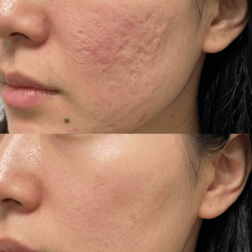 How Many Microneedling Sessions Do You Really Need for Acne Scars?