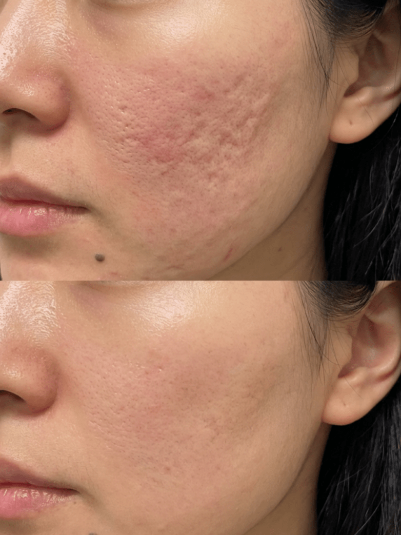 Microneedling in Birmingham: Cost, Results, Downtime & What to Expect