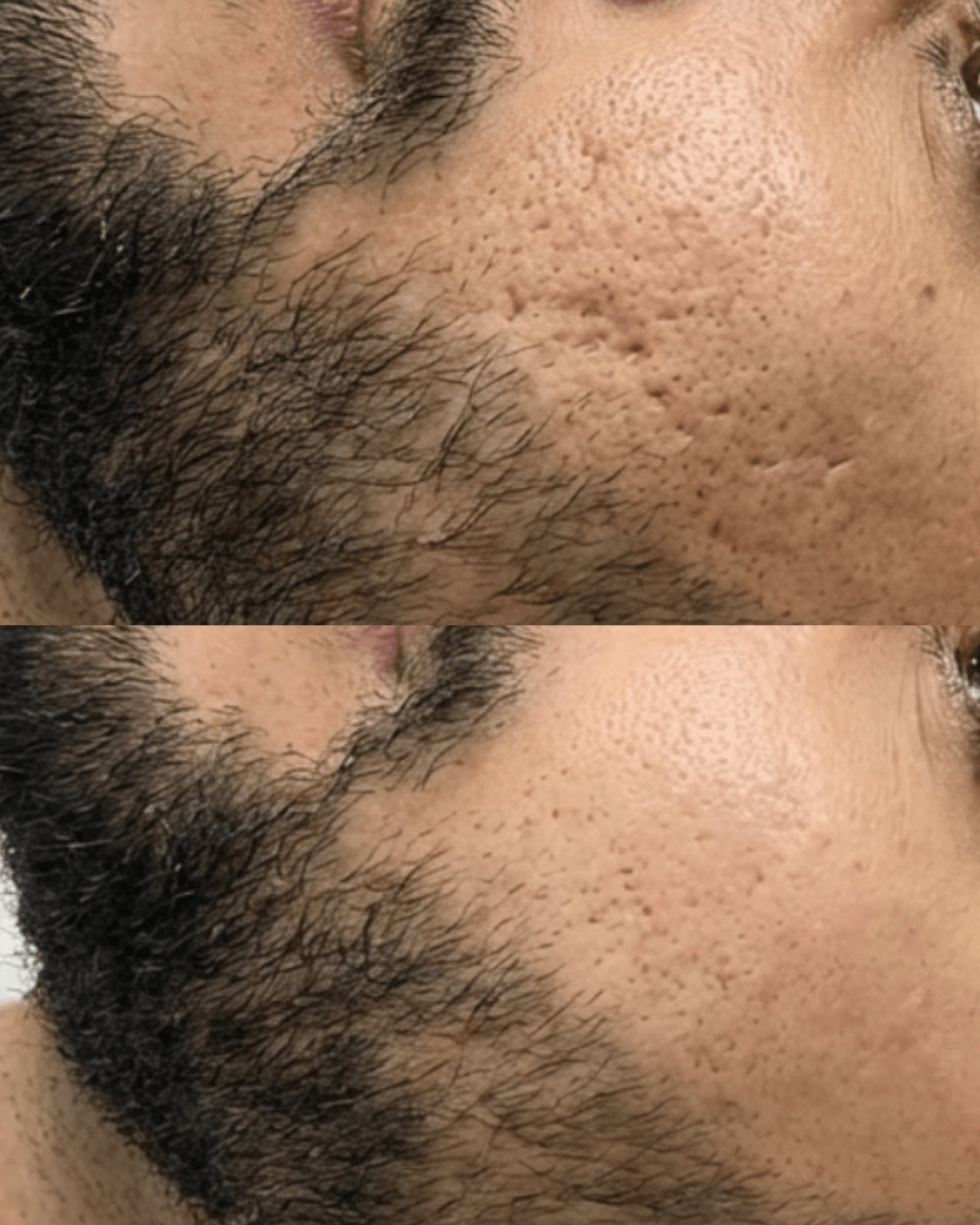 microneedling birmingham