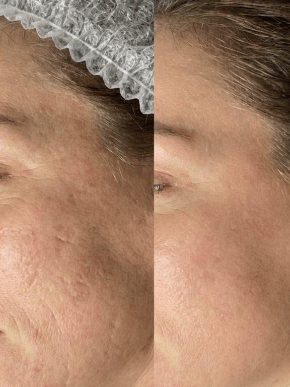 microneedling birmingham