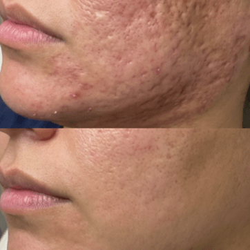 Polynucleotides vs Profhilo: Which Skin Booster Is Better?