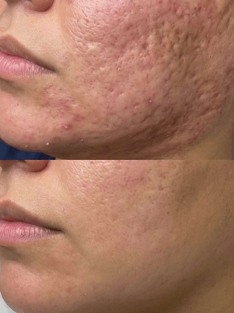 Microneedling Downtime: What Your Skin Looks Like Day-by-Day