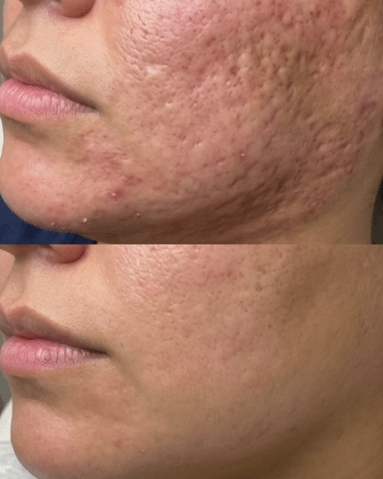 Microneedling Downtime: What Your Skin Looks Like Day-by-Day