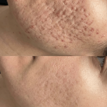 Microneedling in Birmingham: Cost, Results, Downtime & What to Expect