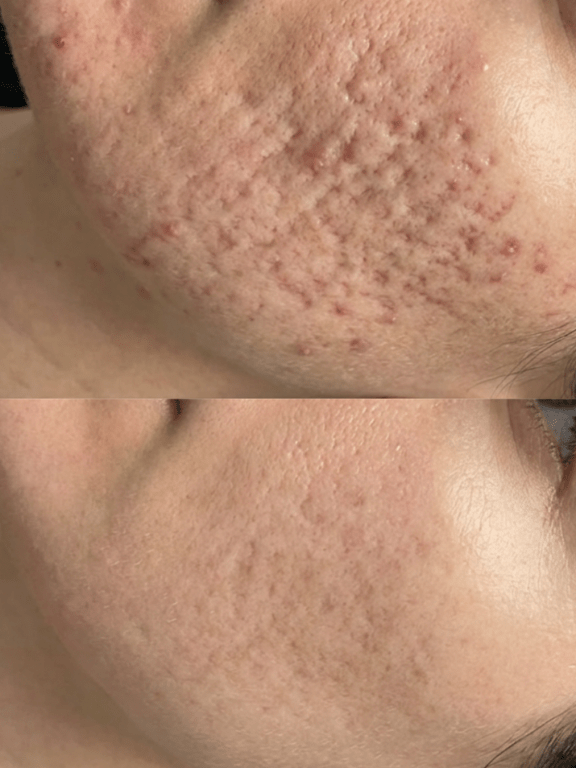 microneedling with exosomes at sorelle skin clinic in birmingham