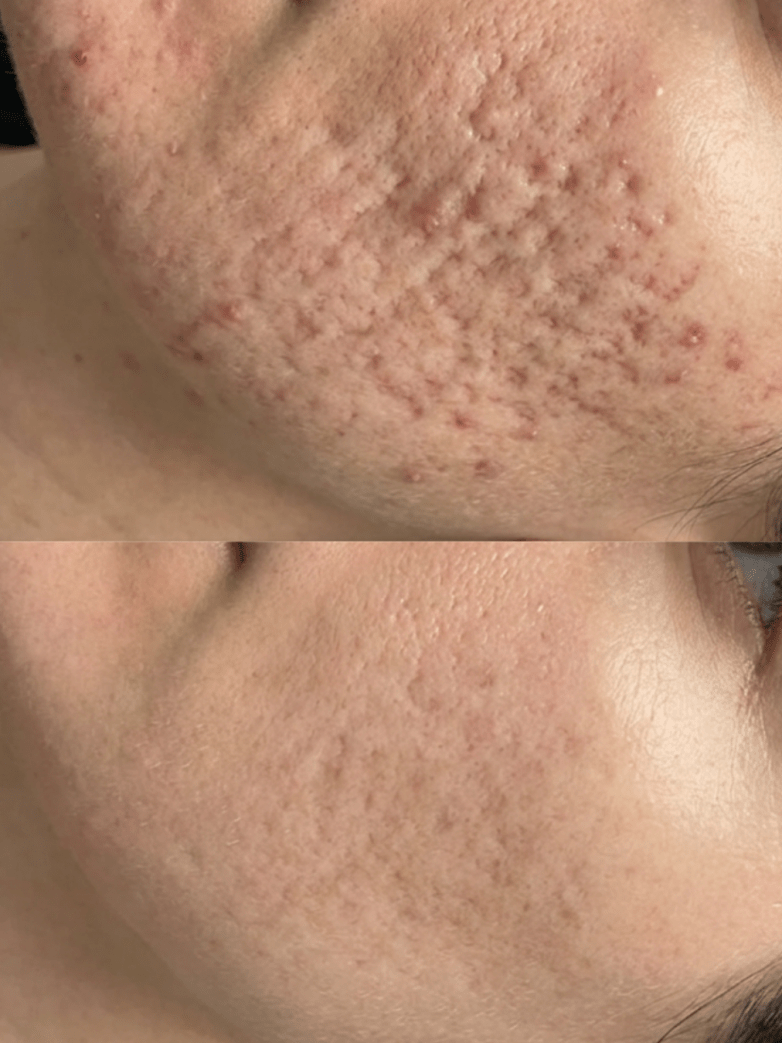 How Many Microneedling Sessions Do You Really Need for Acne Scars?