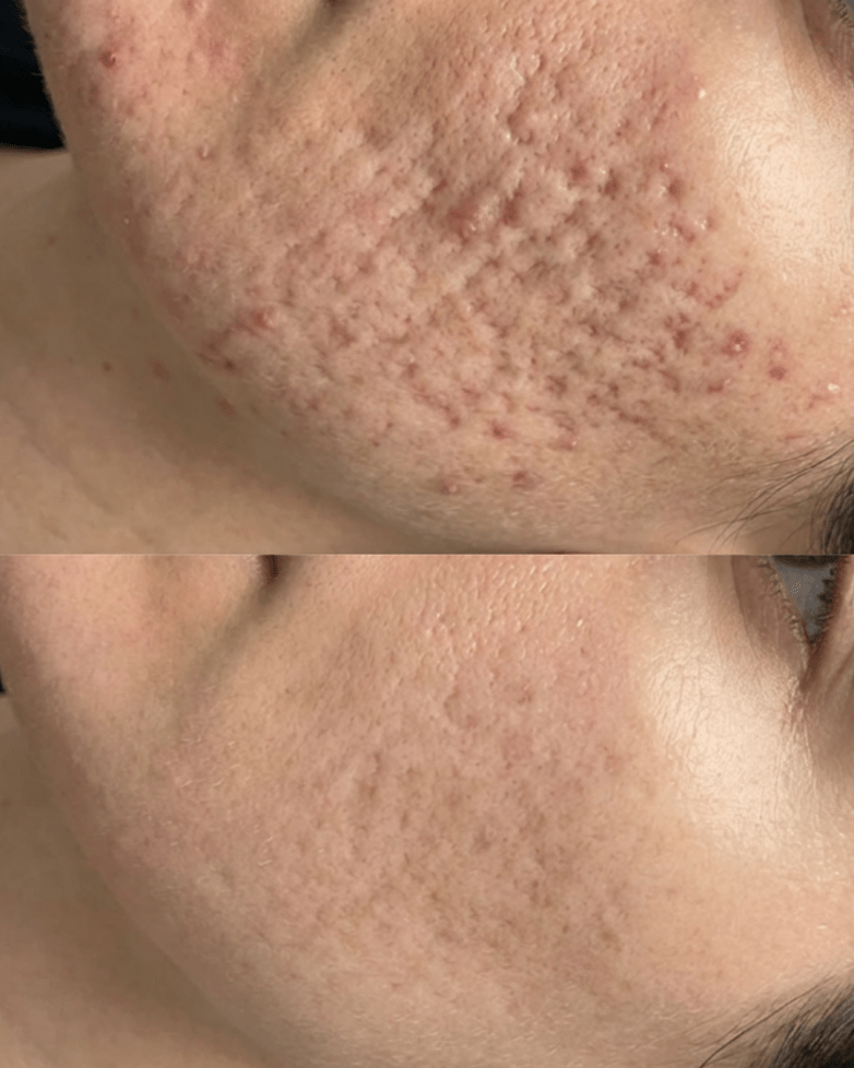 How Many Microneedling Sessions Do You Really Need for Acne Scars?